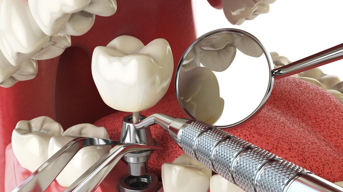 Implants dentaires au Maroc : qui peut en bénéficier ?